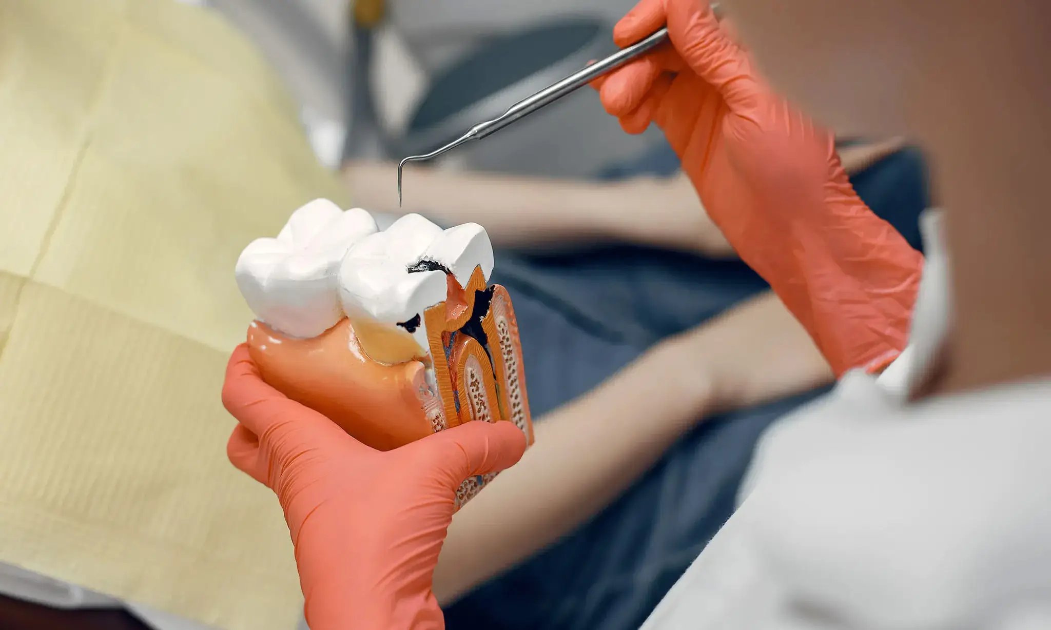 leczenie-endodontyczne-model-zeba-dentysta-smileclinic-pl Dentysta w pomarańczowych rękawiczkach trzyma model zęba i używa narzędzia stomatologicznego do jego badania, na tle stołu z żółtą podkładką. Zdjęcie ilustruje leczenie endodontyczne, które pozwala uratować zęby przed usunięciem, związane z usługami kliniki stomatologicznej SmileClinic.