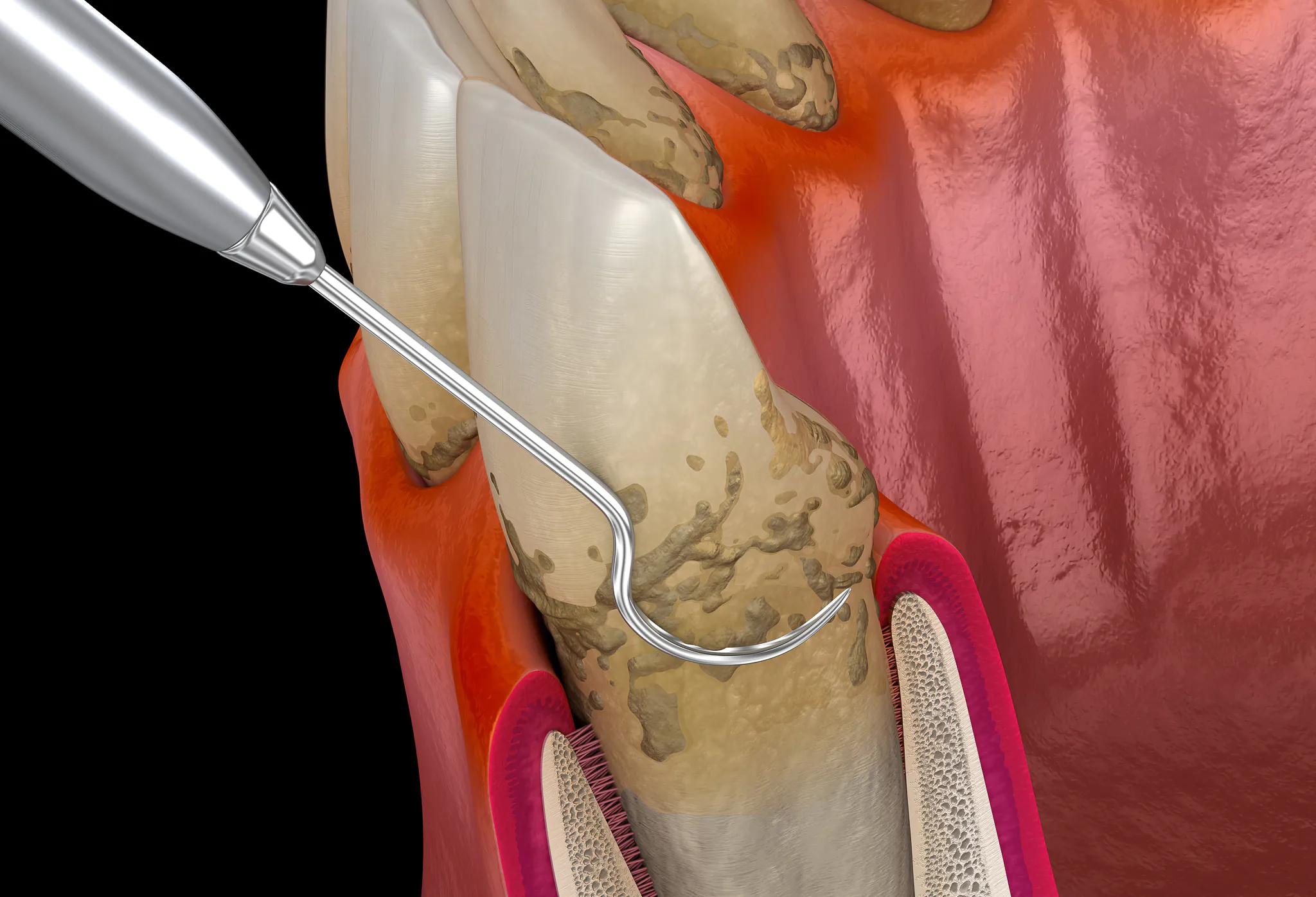 Specjalistyczne leczenie paradontozy w SmileClinic - procedura oczyszczania kieszonek dziąsłowych przy użyciu precyzyjnych narzędzi periodontologicznych, usuwająca kamień nazębny z powierzchni korzenia.