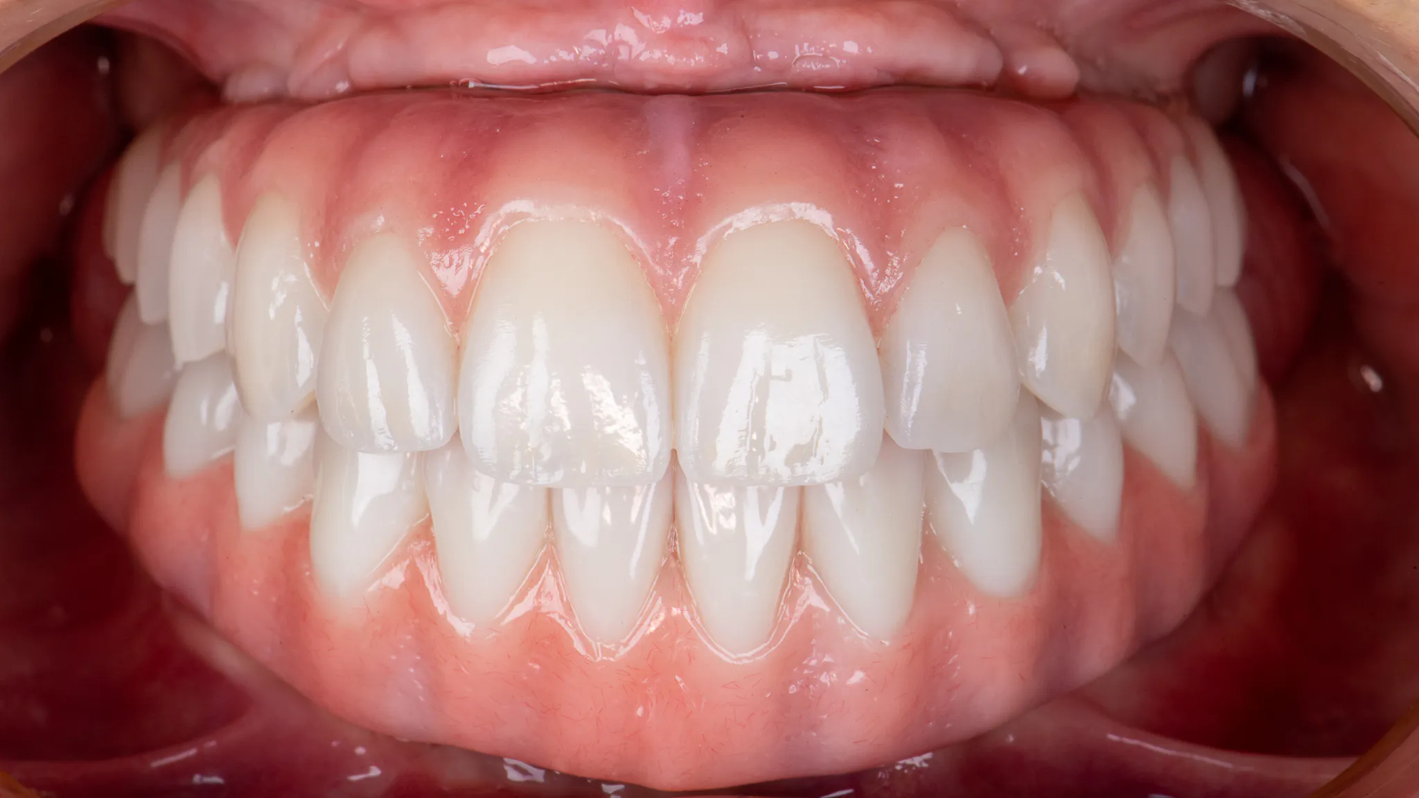 Finalna proteza All-on-4 wykonana w SmileClinic - pełna rekonstrukcja uzębienia na implantach perfekcyjnie odtwarzająca naturalny wygląd zębów i zapewniająca harmonijne przejście między uzupełnieniem a zdrowym dziąsłem.