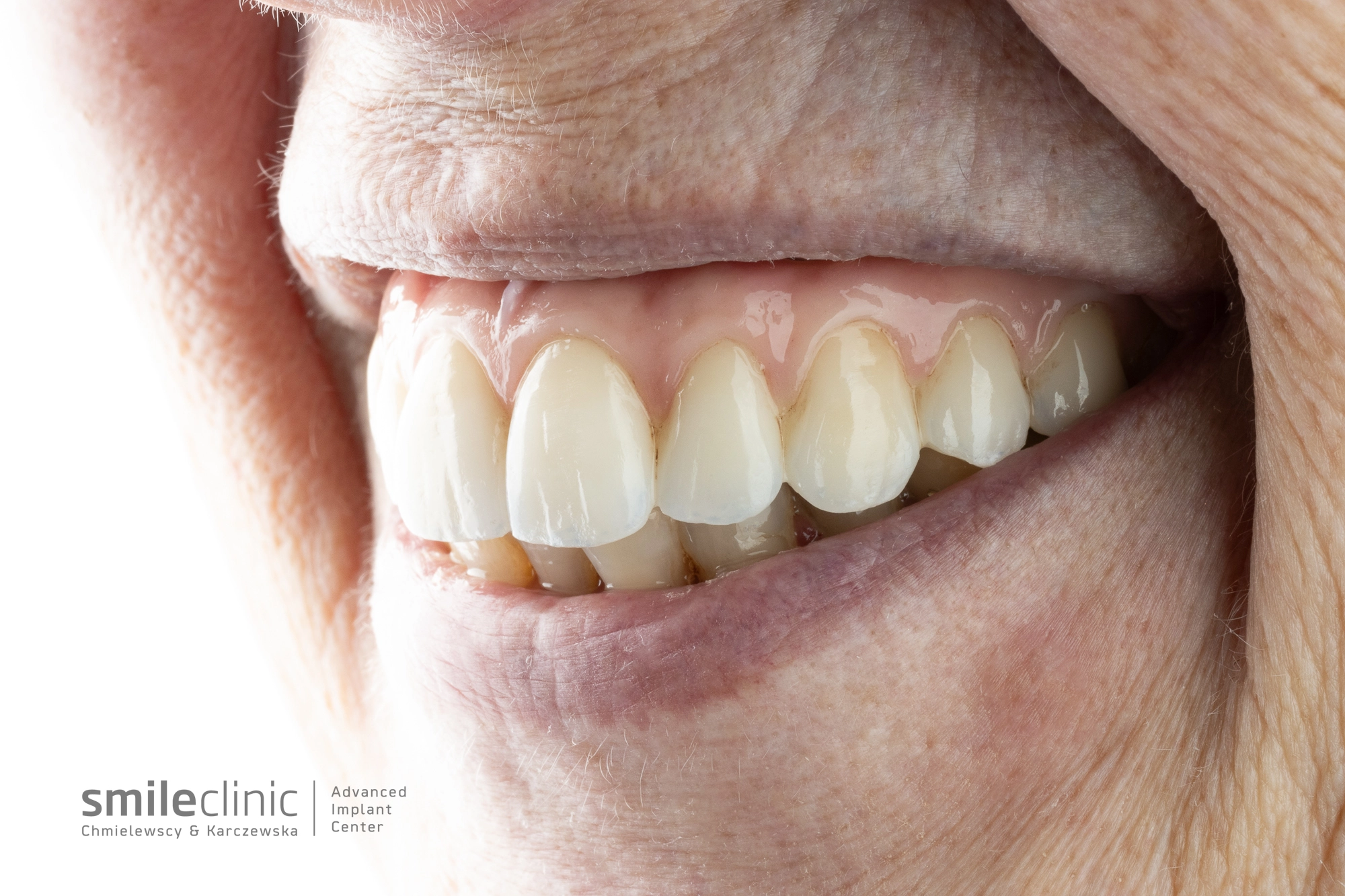 Efekt leczenia implantologicznego w SmileClinic - naturalne i estetyczne uzupełnienie zębów na implantach u starszego pacjenta, przywracające pełną funkcjonalność i pewność siebie.