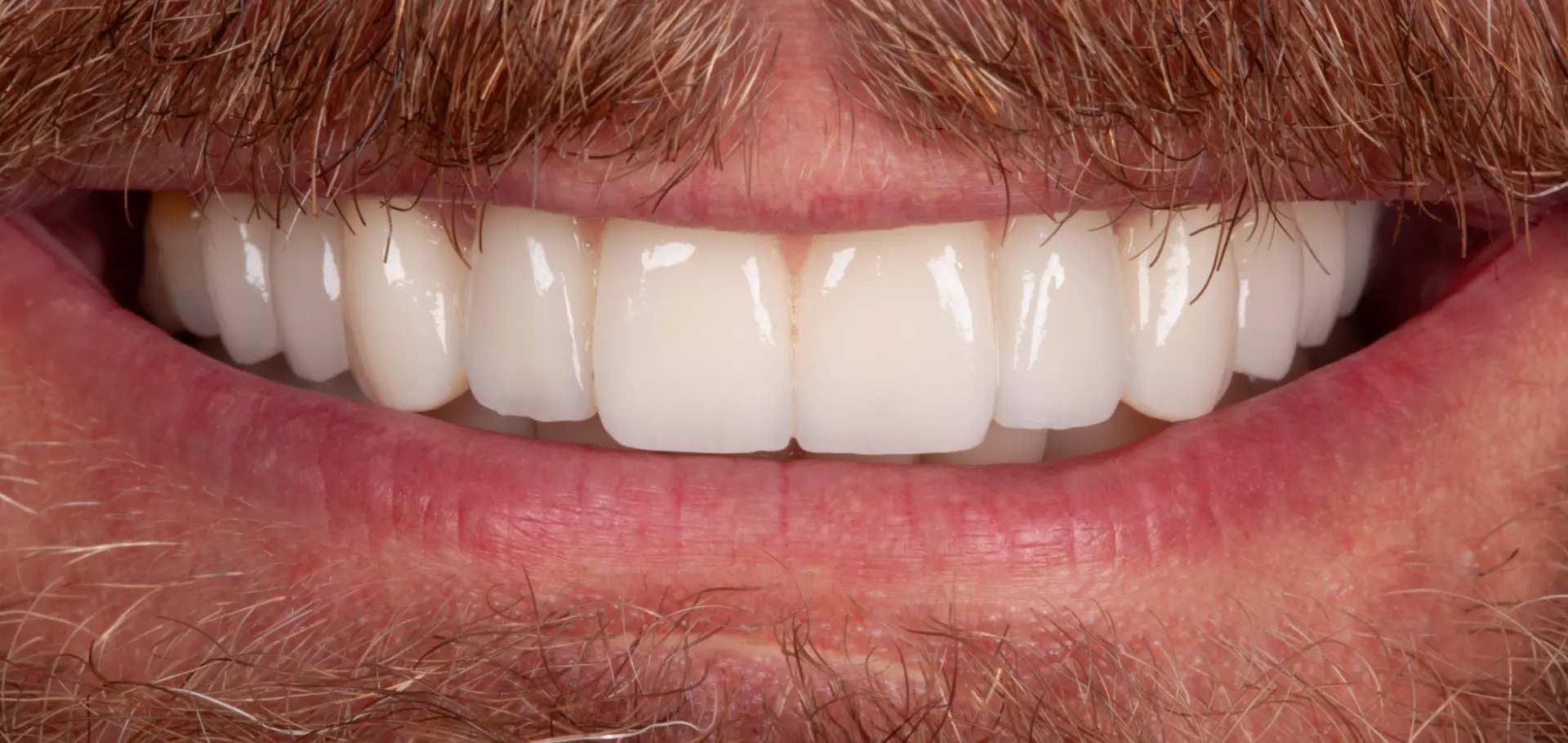 Perfekcyjnie wykonane implanty zębów przednich w SmileClinic - przykład implantologii estetycznej, gdzie korony na implantach są nie do odróżnienia od naturalnych zębów, dzięki zastosowaniu nowoczesnych technik i materiałów odtwarzających właściwą barwę i przezierność.