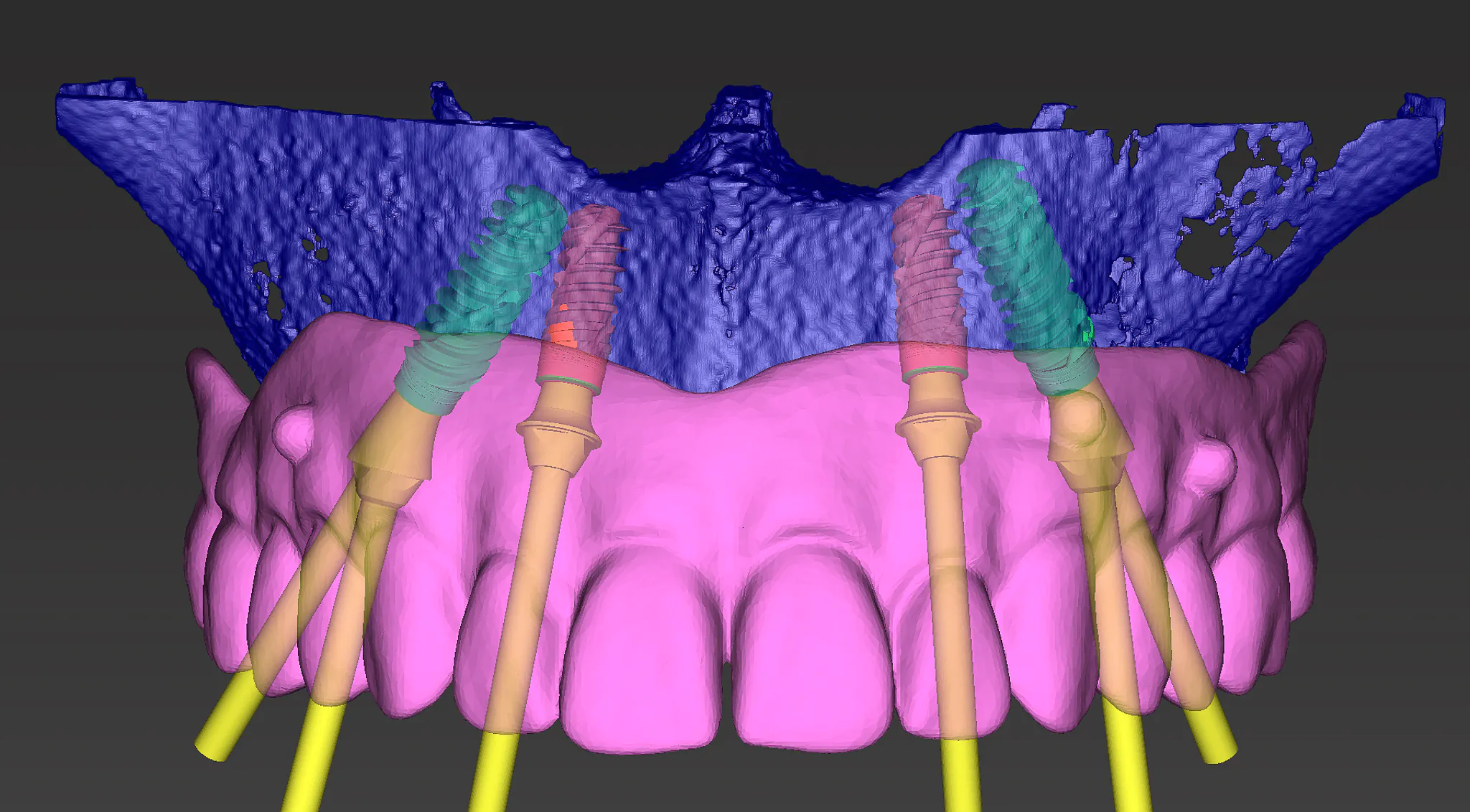 Zaawansowane planowanie komputerowe 3D w SmileClinic pokazujące detale zabiegu All-on-4 z uwzględnieniem struktury kości, pozycji implantów i docelowej protezy.