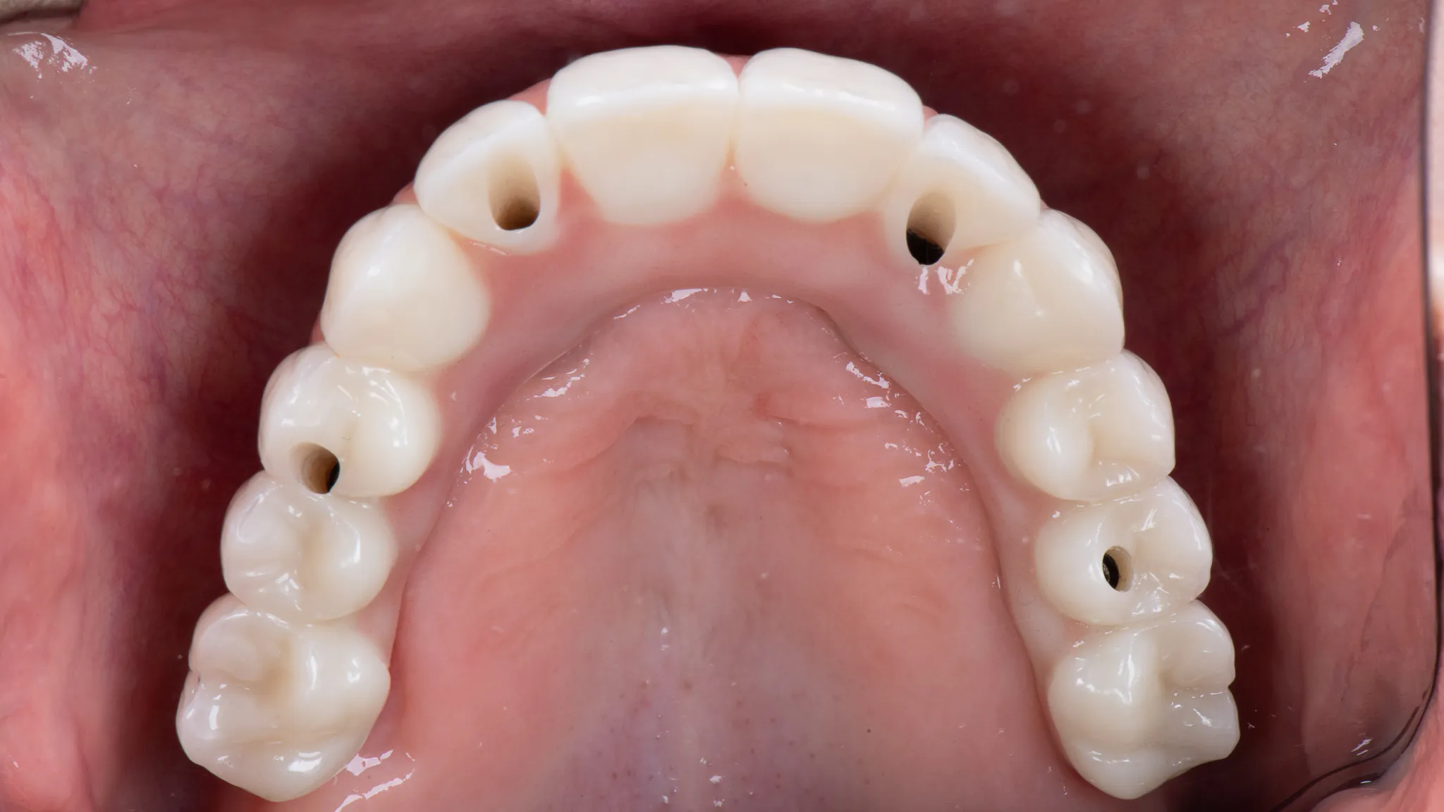Precyzyjnie wykonana górna proteza All-on-4 w SmileClinic z widocznymi punktami kotwiczenia na implantach zapewniającymi stabilność i komfort użytkowania.