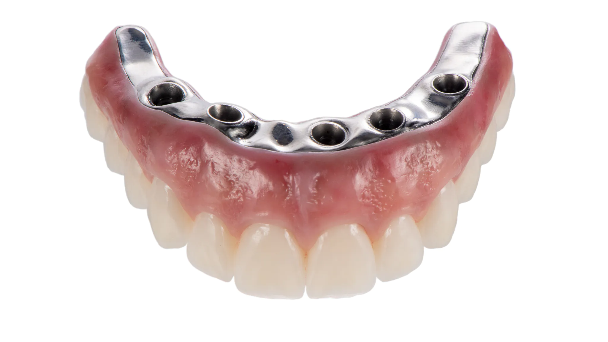 Górna proteza zębowa typu All-on-4 z precyzyjnym systemem mocowania belkowego zapewniającym stabilność i komfort użytkowania po leczeniu w SmileClinic.