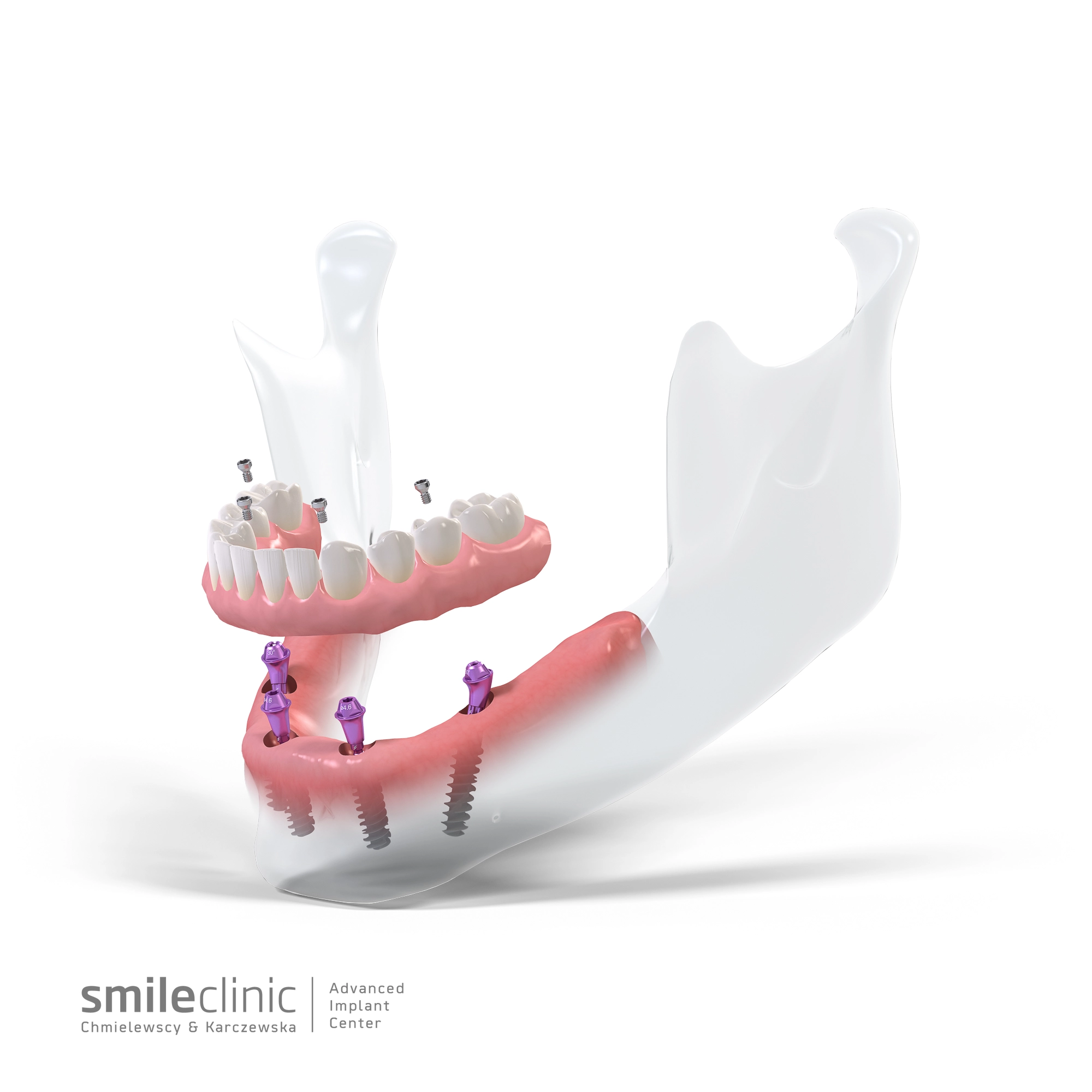 Innowacyjny system implantologiczny All-on-4 stosowany w SmileClinic - wizualizacja pokazująca precyzyjne rozmieszczenie czterech implantów podtrzymujących pełny łuk zębowy, pozwalając na natychmiastowe obciążenie i funkcjonowanie.
