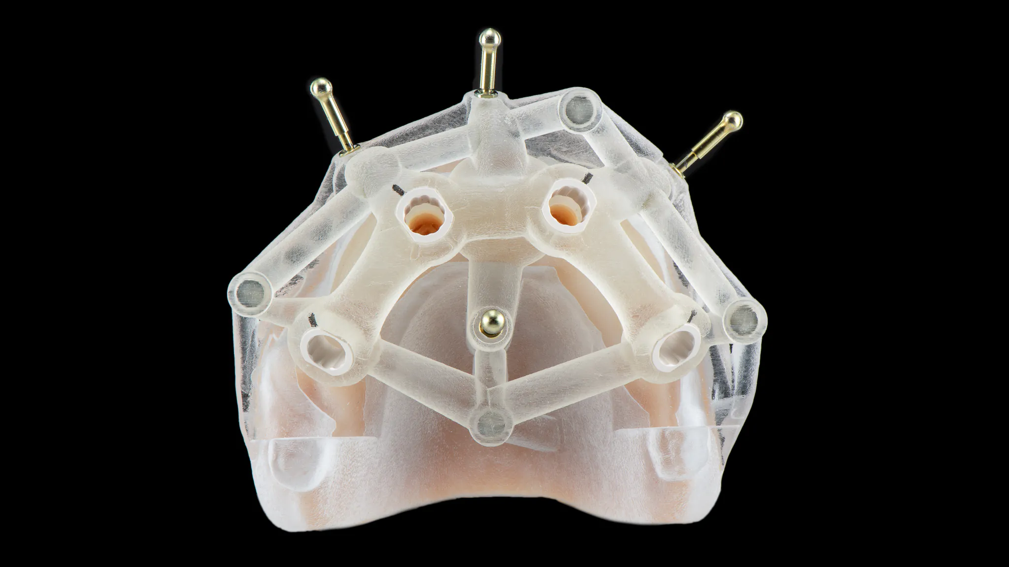 Zaawansowane planowanie zabiegu All-on-4 w SmileClinic z użyciem precyzyjnego szablonu chirurgicznego zapewniającego dokładne pozycjonowanie implantów.