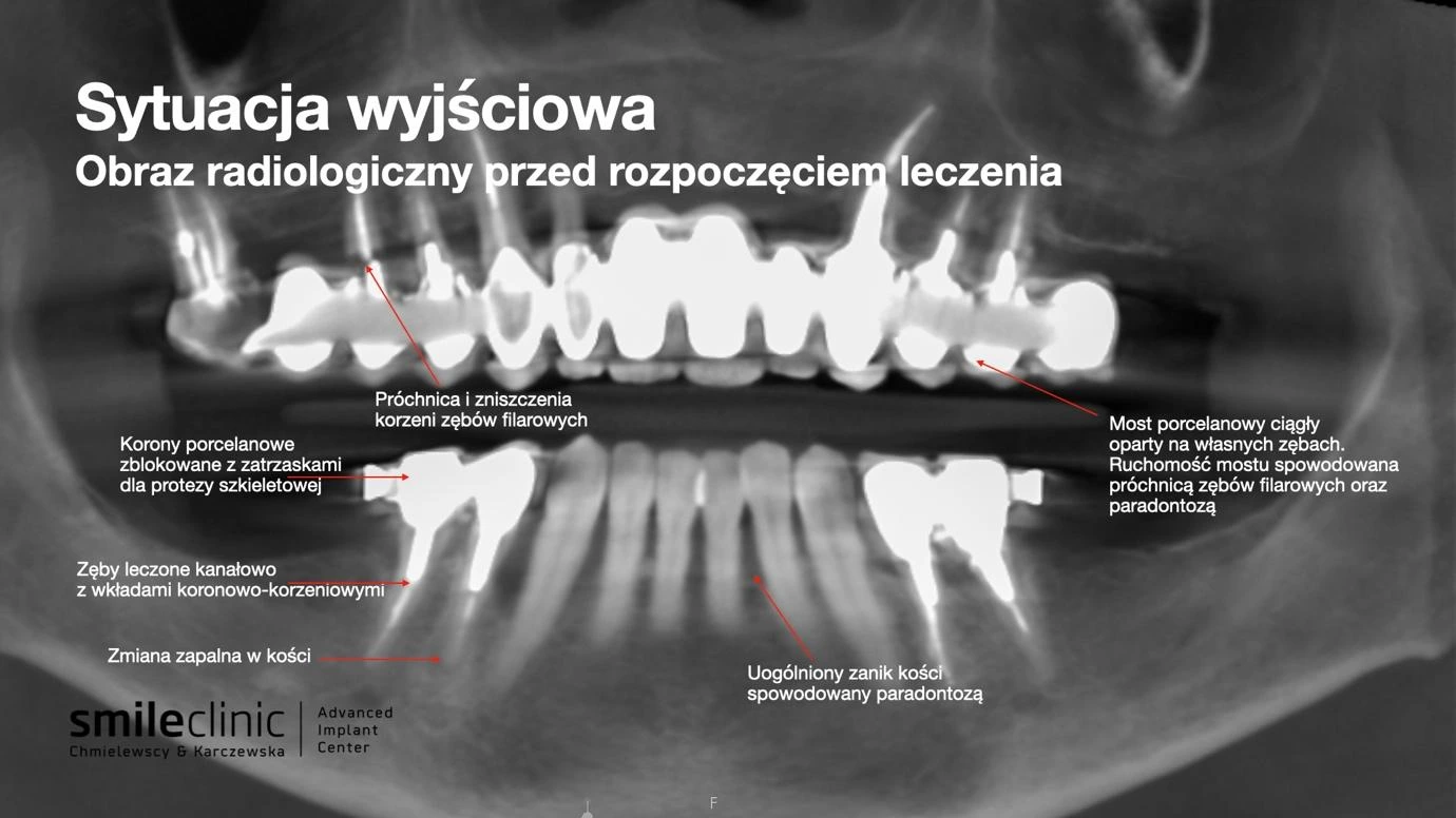 Obraz radiologiczny przed leczeniem implantologicznym All-on-6 – próchnica i zanik kości