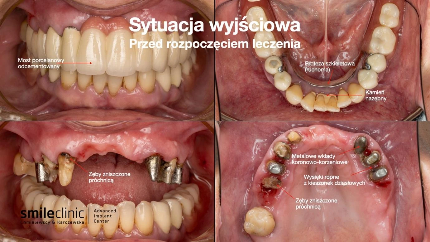 Sytuacja wyjściowa jamy ustnej pacjentki przed leczeniem implantologicznym All-on-6