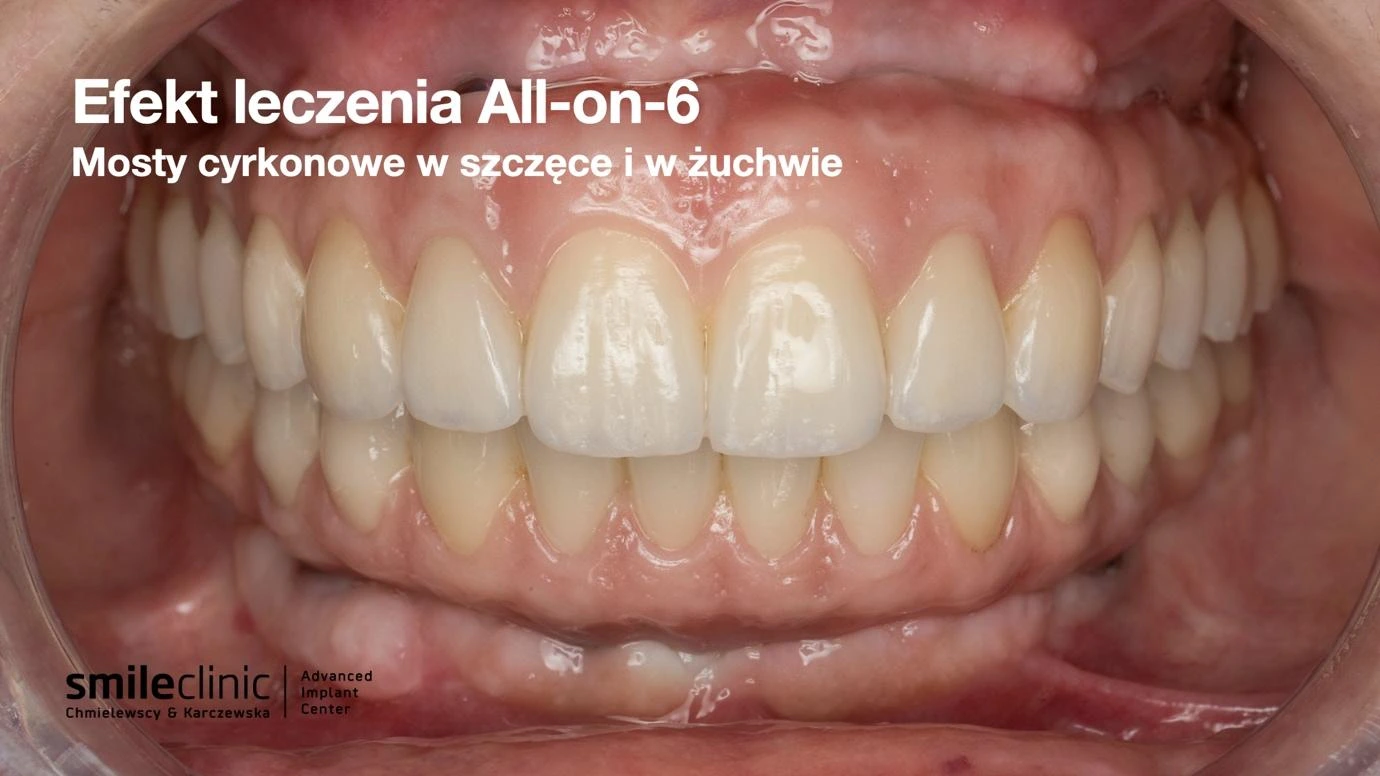 Mosty cyrkonowe na implantach All-on-6 w szczęce i żuchwie
