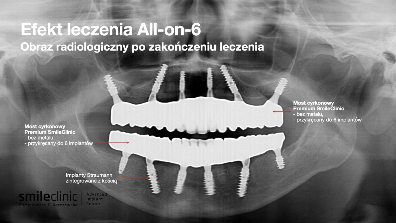 Obraz radiologiczny po leczeniu implantologicznym All-on-6 – mosty cyrkonowe na implantach Straumann