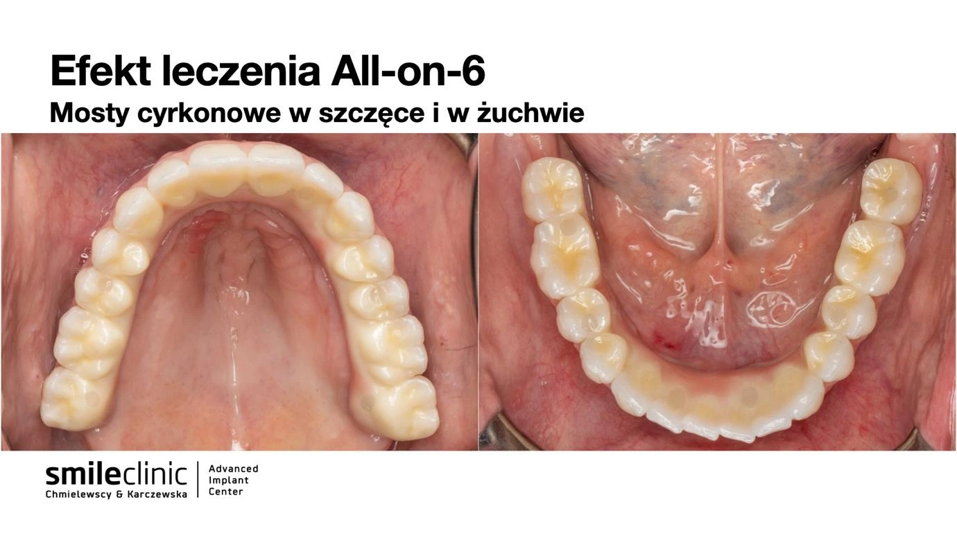 Widok od góry i od dołu mostów cyrkonowych na implantach All-on-6
