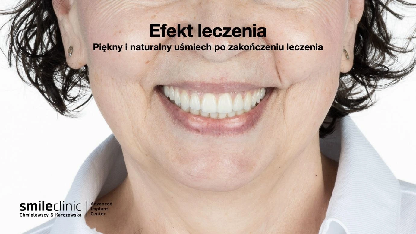 Piękny i naturalny uśmiech po leczeniu implantologicznym All-on-6