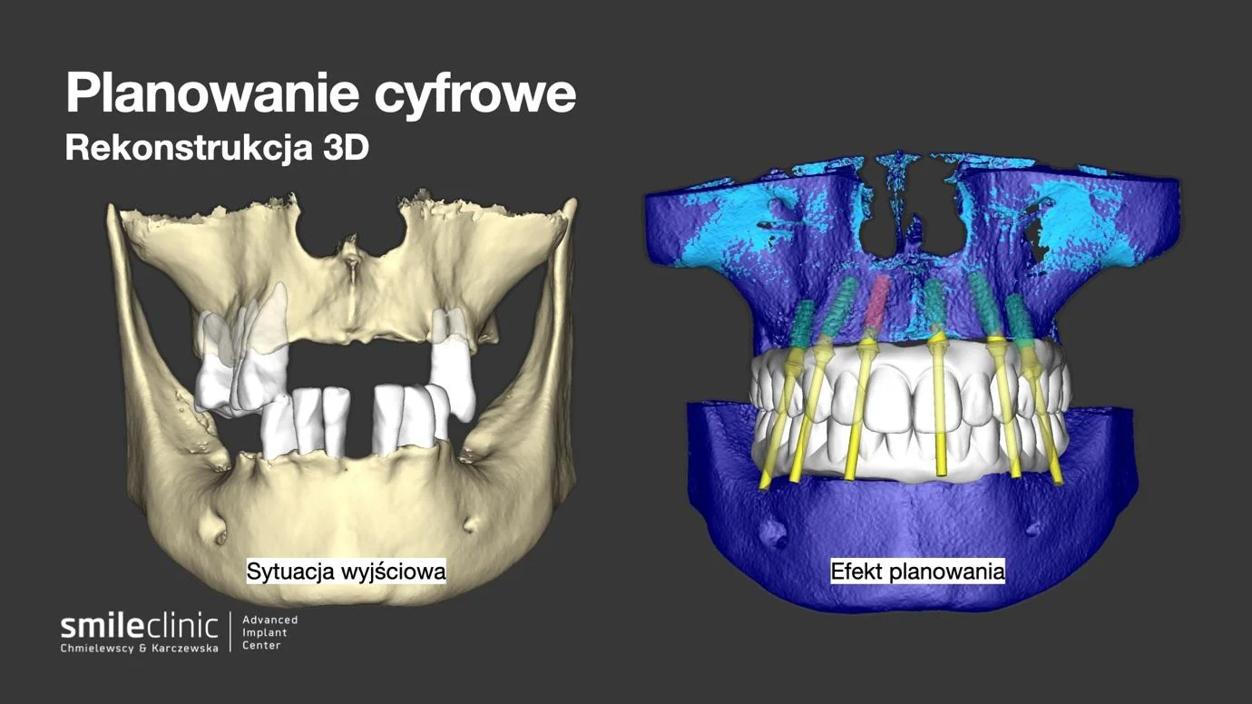 Porównanie cyfrowej rekonstrukcji 3D szczęki przed leczeniem implantologicznym i po zaplanowaniu pozycji implantów