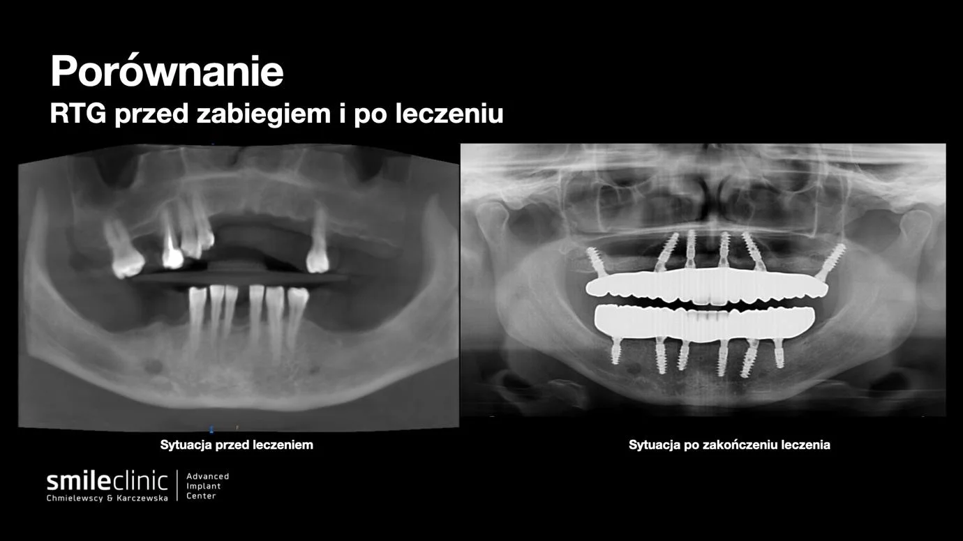Porównanie zdjęć RTG pacjentki przed leczeniem implantologicznym i po zakończeniu terapii All-on-6