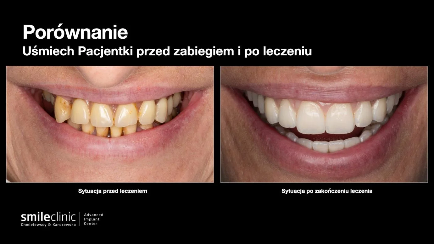 Zbliżenie uśmiechu pacjentki przed leczeniem implantologicznym i po jego zakończeniu