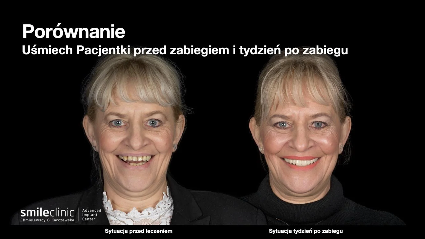 Porównanie uśmiechu pacjentki przed leczeniem implantologicznym i tydzień po zabiegu