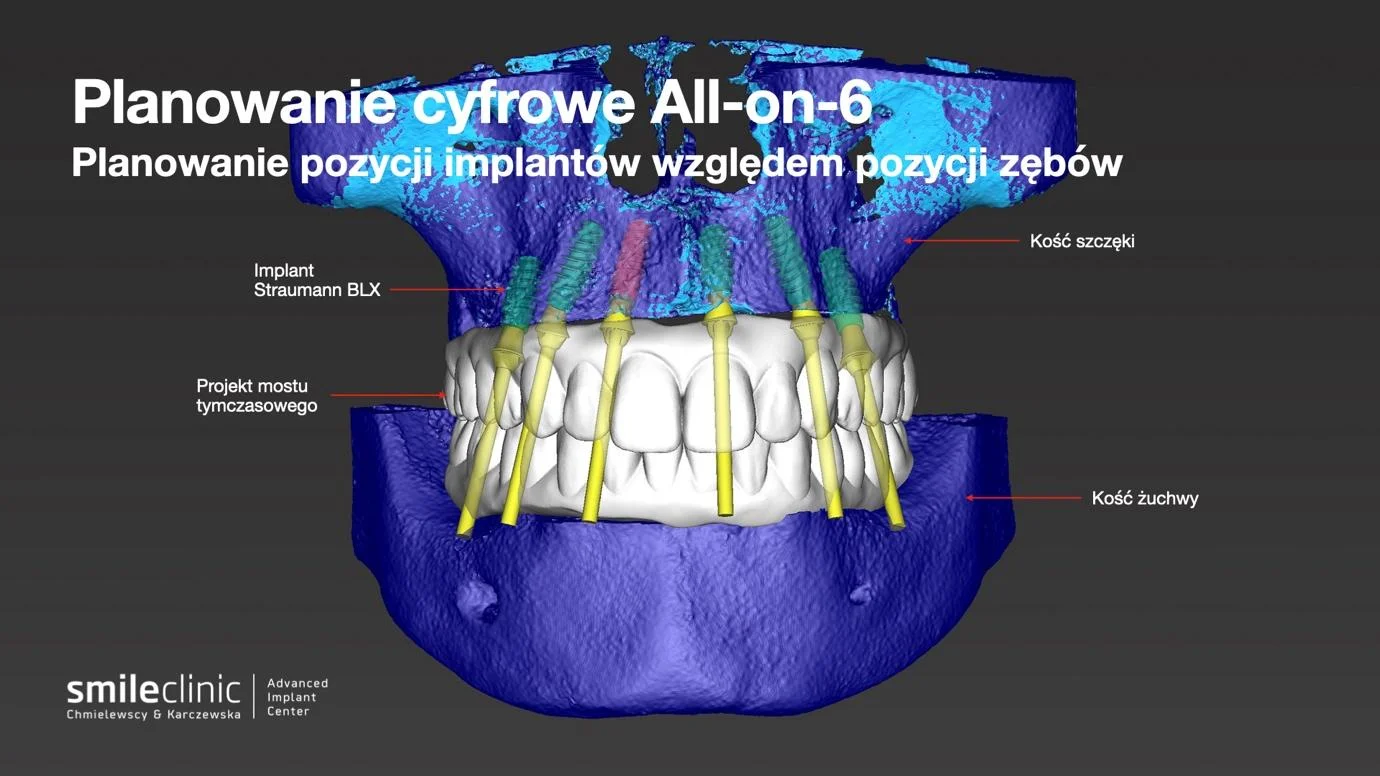 Wizualizacja cyfrowego planowania implantów zębowych w technice All-on-6 z oznaczeniem kości i pozycji implantów