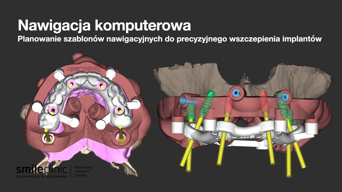 Nawigacja komputerowa podczas planowania implantów All-on-6