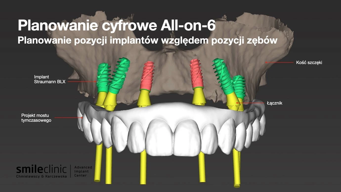 Planowanie cyfrowe implantów zębowych All-on-6 – wizualizacja pozycji implantów Straumann BLX