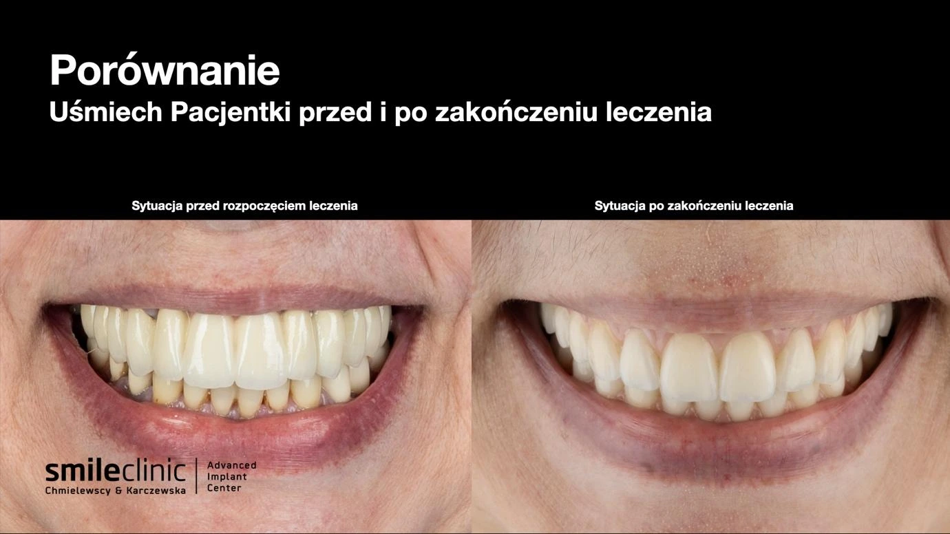 Porównanie uśmiechu pacjentki przed i po leczeniu All-on-6