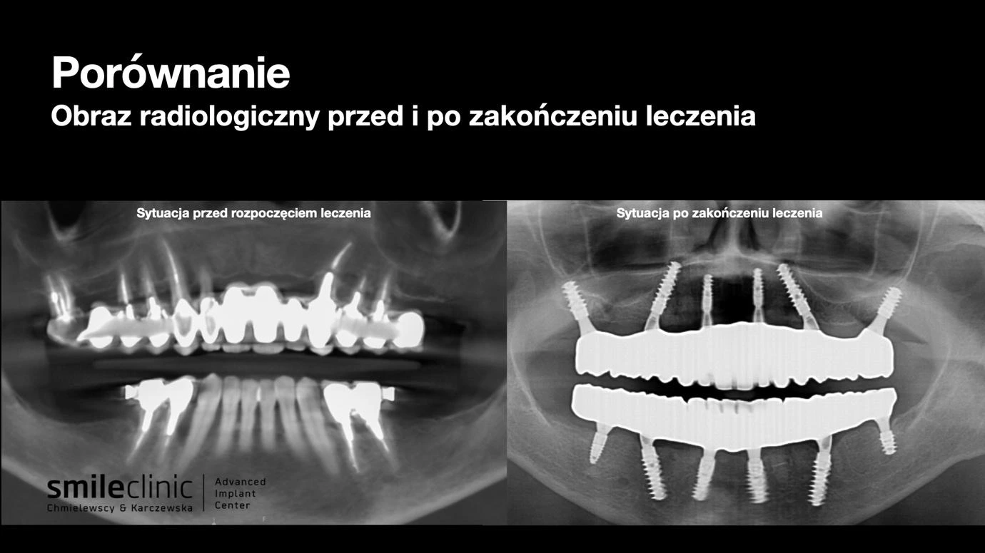 Zdjęcie RTG przed i po leczeniu implantologicznym All-on-6