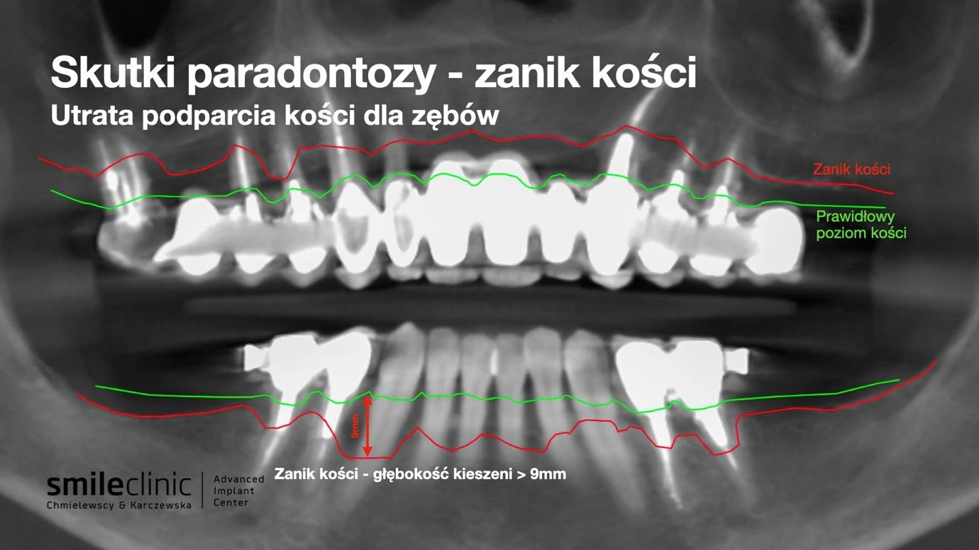 Skutki paradontozy – zanik kości i utrata podparcia dla zębów