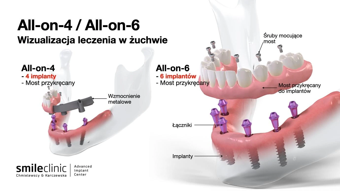Porównanie metod All-on-4 i All-on-6 – wizualizacja leczenia implantologicznego
